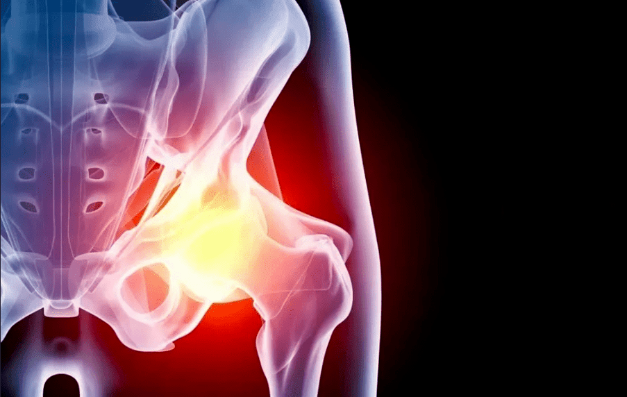 Osteoartrită a tratamentului articulației șoldului drept